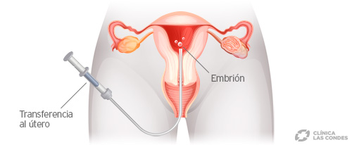 Transferencia embrionaria