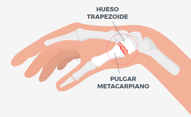 Artrosis dedos mano: qué es, síntomas y tratamiento