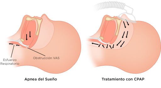 control a distancia del CPAP