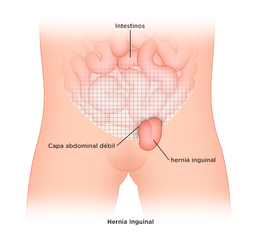 hernia inguinal