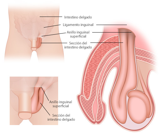 hernia inguinal