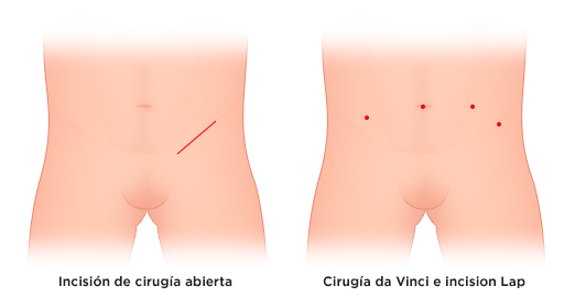 hernia inguinal