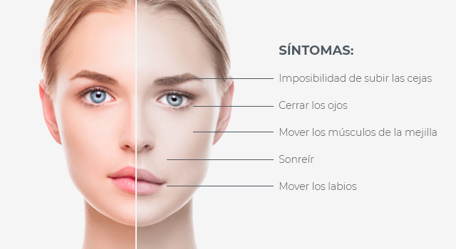 síntomas de parálisis facial