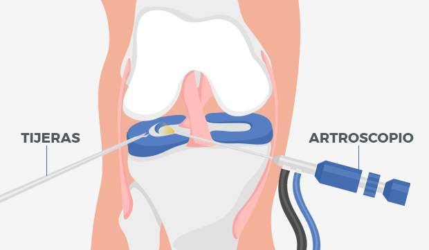 artroscopía de rodilla