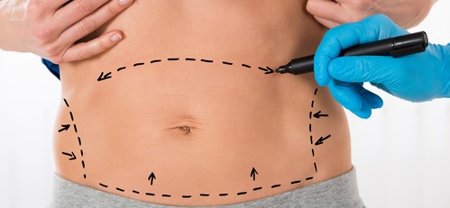 Abdominoplastía