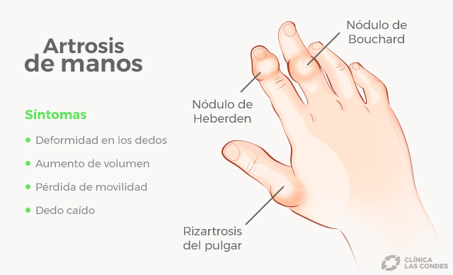 Dolor y deformidad los dedos: atentos a la artrosis de - Clínica Las Condes