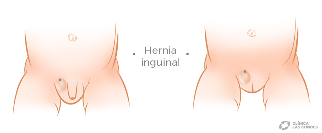 Hernia Inguinal