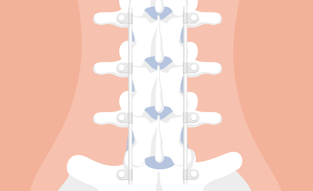 Fijación y artrodesis de columna: Una solución a la inestabilidad - Clínica  Las Condes