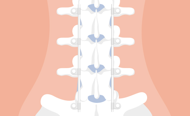 Fijación de columna