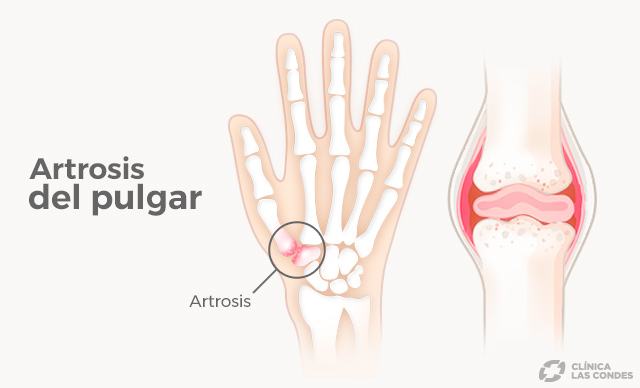 artrosis de pulgar