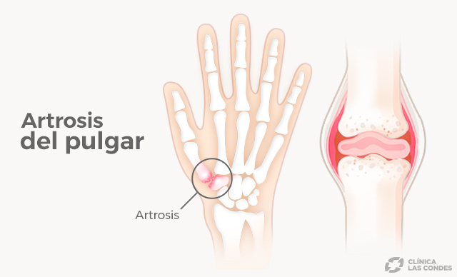 artrosis de pulgar