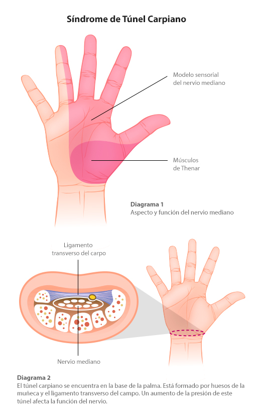 Síndrome del túnel carpiano - I-Tech Medical Division