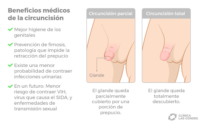 tipos de circuncisión