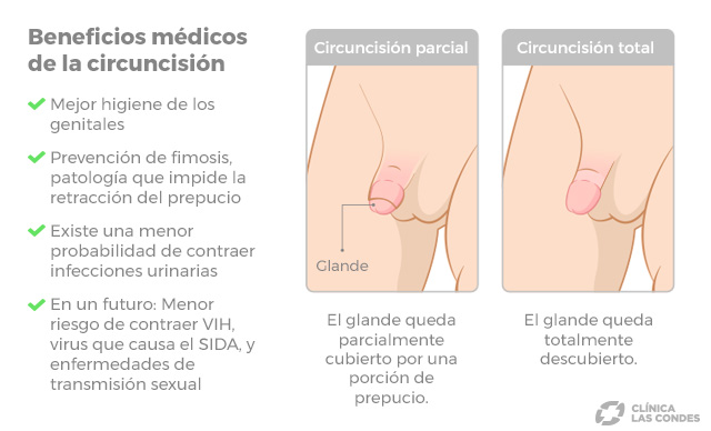 tipos de circuncisión