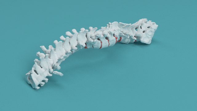 Lumbar 3d