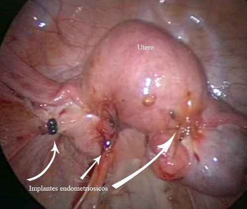 Endometriosis pelviana