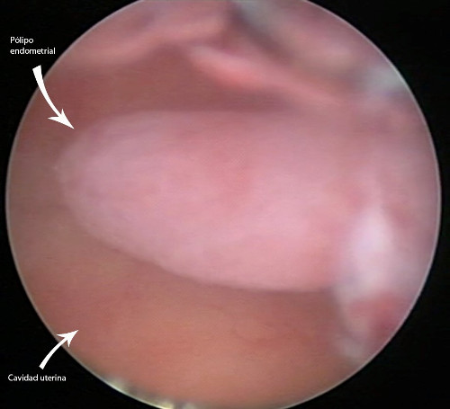 pólipos endometriales