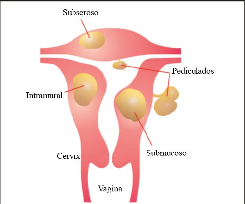 ubicación de los miomas uterinos