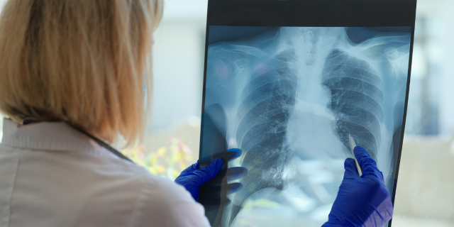 SÍNTOMAS DE TUBERCULOSIS: SEÑALES DE ALARMA Y PREVENCIÓN