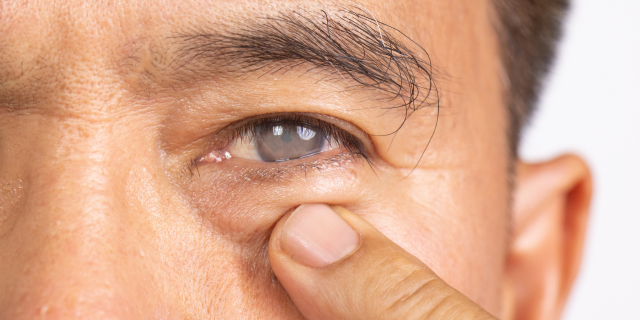 GLAUCOMA: POR QUÉ EL CHEQUEO DESDE LOS 40 PUEDE SALVAR VISIÓN