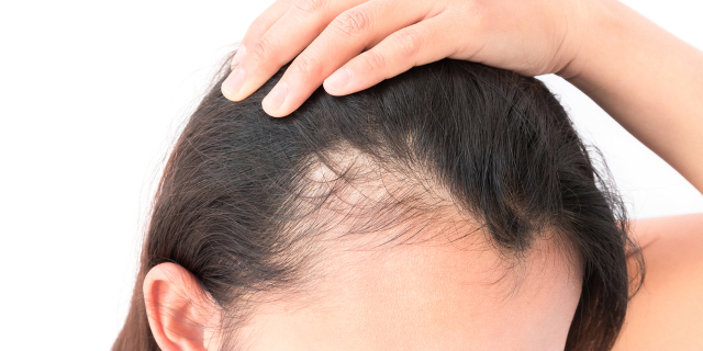 Efluvio telógeno: el cabello que se cae tras embarazo - Clínica Las Condes